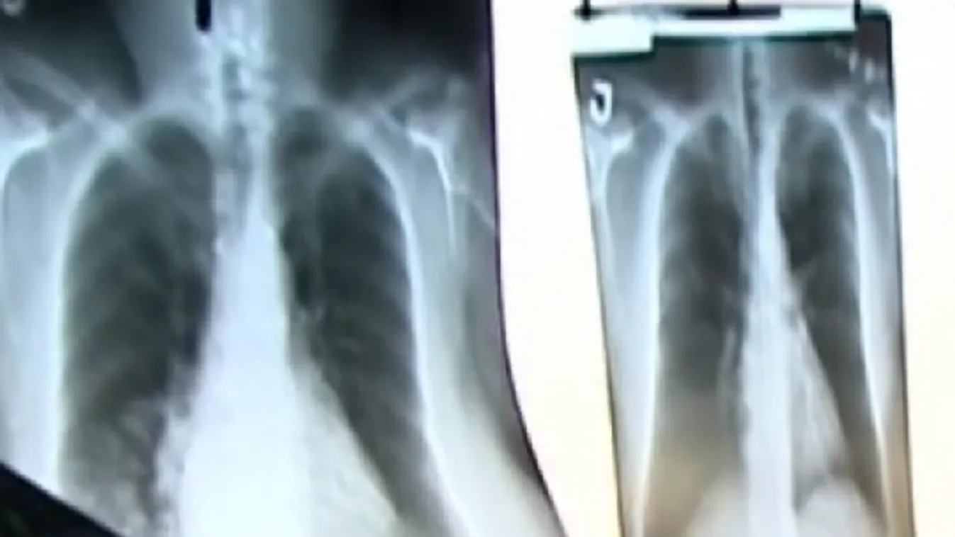 Ezek a covid tünetek kezdeti tüdőrákra is utalhatnak