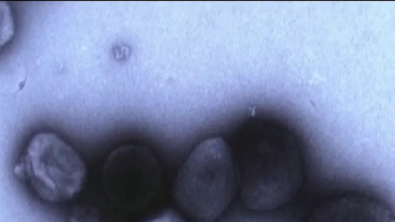 Újabb európai országban bukkant fel a majomhimlő