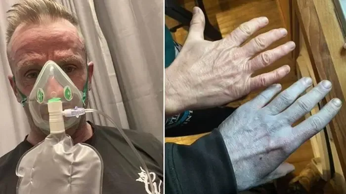 „Úgy néztem ki, mint egy Avatar” – rejtélyes tünet miatt került kórházba egy férfi